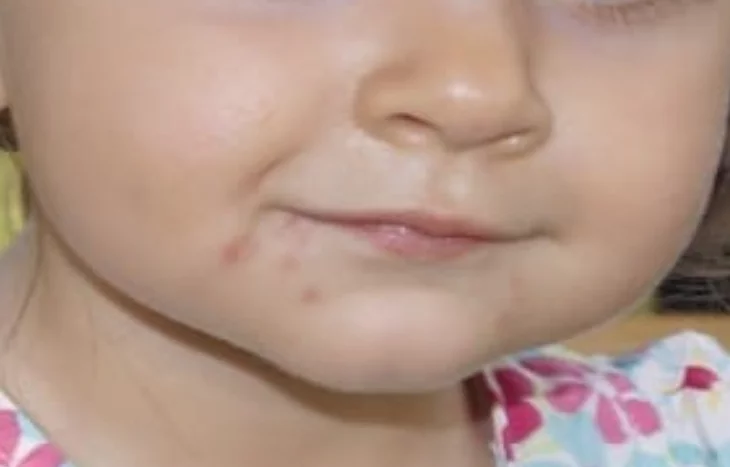 Hand-Mund-Fuß-Krankheit bei Kindern: Symptome, Ansteckung und Prävention